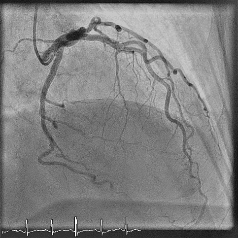 Coronary Angiography