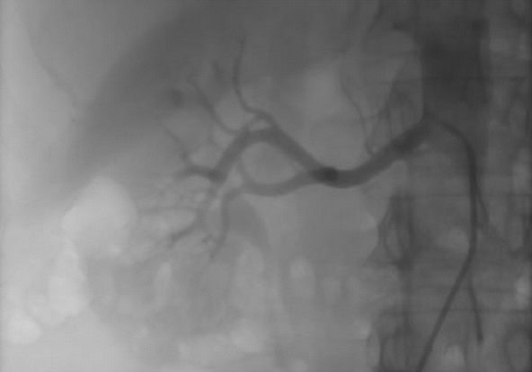 Renal Denervation