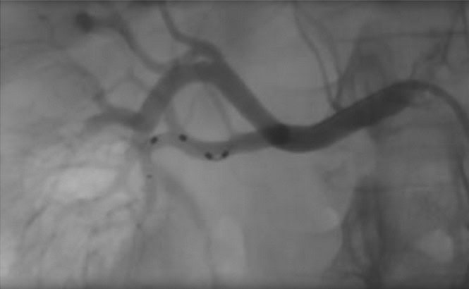 Renal Denervation 2