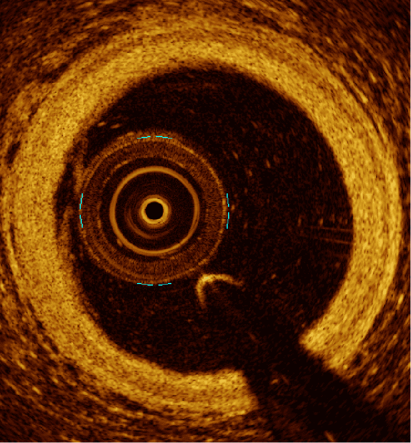 Imagerie intracoronarienne (IVUS / OCT)